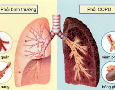 Bỏ 6 loại món gây ung thư phổi