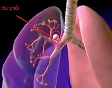 Mỗi năm Việt Nam có 19.500 người tử vong vì ung thư phổi