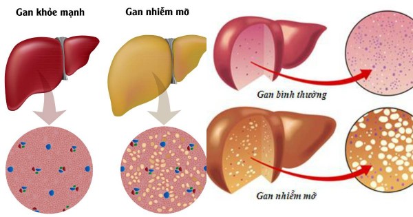 Gan nhiễm mỡ, tránh ăn gì?