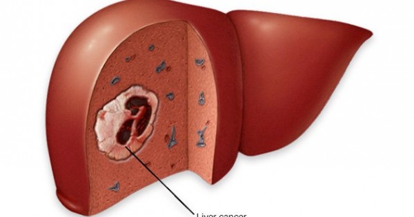 Triệu chứng khó ngờ vùng bụng, nghĩ ngay ung thư gan