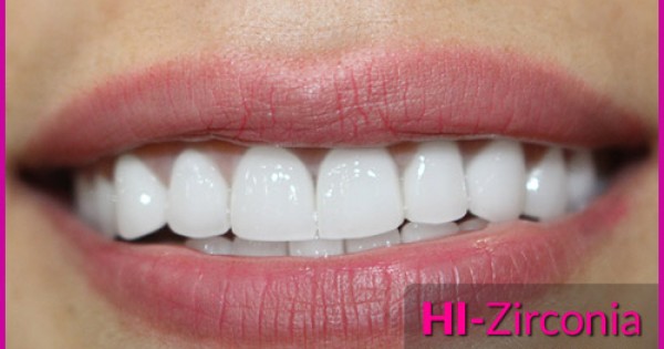 Ra mắt răng sứ cao cấp HI–Zirconia, Nha Khoa Đông Nam giảm giá