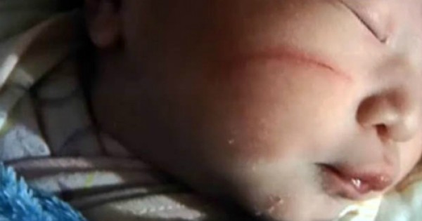 Bác sĩ Trung Quốc làm rách mặt bé sơ sinh khi đẻ mổ