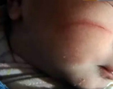 Bác sĩ Trung Quốc làm rách mặt bé sơ sinh khi đẻ mổ