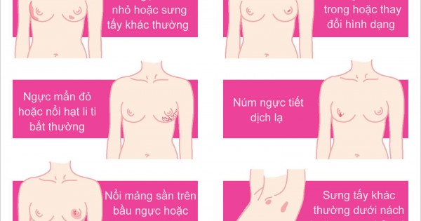 Cần khám định kỳ để tầm soát ung thư vú