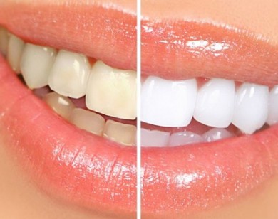 Răng bạn có vàng ố tới mấy cũng trắng ngay lập tức khi dùng chanh cách này