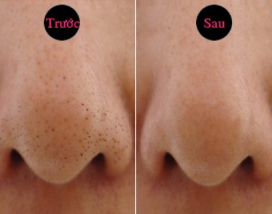 5 công thức trị sạch mụn đầu đen bằng trứng gà ai cũng làm được