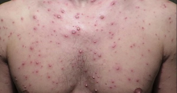 Phát hiện 17 ca bệnh thủy đậu ở Kon Tum sau Tết nguyên đán