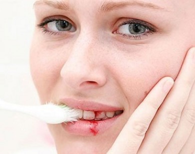 Nếu bị chảy máu chân răng bạn hãy đi khám ngay lập tức