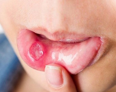Đảm bảo hết nhiệt miệng sau 1 đêm mà không phải uống thuốc tây