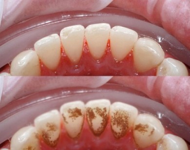 5 phút giúp răng sáng cực nhanh không cần phải đi nha sĩ
