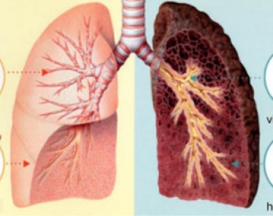 Thủ phạm hàng đầu gây nên bệnh ung thư phổi