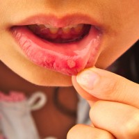 Chỉ cần uống loại nước rẻ tiền này bạn sẽ không bao giờ bị nhiệt miệng