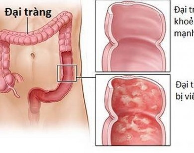 Bài thuốc trị chứng đại tràng thấp nhiệt