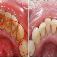 Cao răng dày tới mấy cũng bật ra từng mảng, hôi miệng kinh niên cũng khỏi ngay lập tức