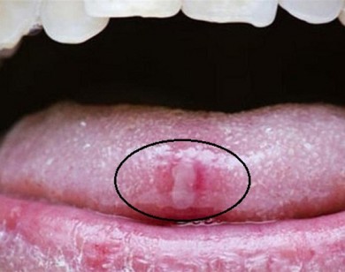 Ung thư lưỡi dễ nhầm là bệnh răng miệng thông thường