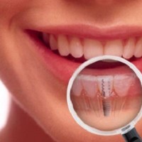 Trồng răng cửa bao nhiêu tiền?