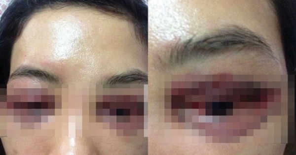 Spa bị 'tố' cắt mí hỏng: Sở Y tế Hà Nội yêu cầu làm rõ