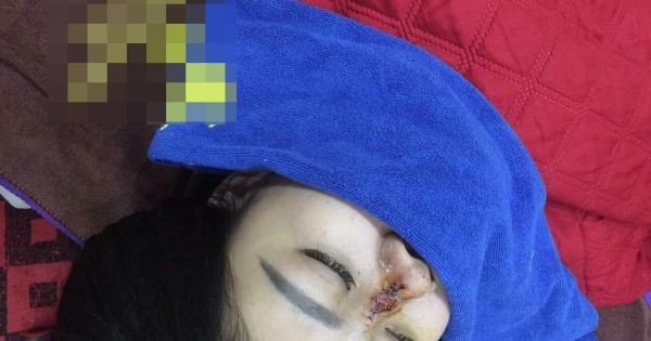 Bắc Giang: Kinh hoàng cô gái bị hoại tử mũi vì tin lời 'bác sĩ' 17 tuổi