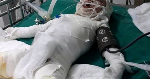 Bé gái 3 tuổi ngã xuống hố vôi đã qua đời