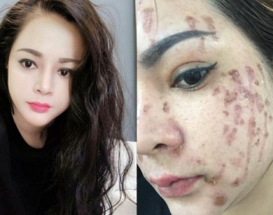 Cô gái trẻ cháy mặt vì nghe lời spa chấm nám