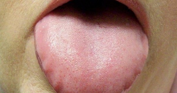 Lưỡi có biểu hiện này coi chừng bệnh đau dạ dày