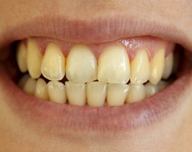 Bí quyết giúp răng không bị tình trạng ố vàng
