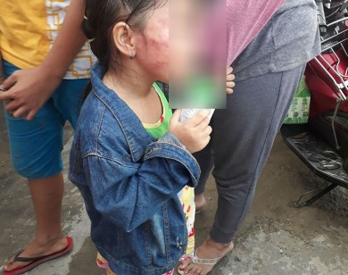 Bắt khẩn cấp cô giáo đánh trẻ "nứt xương hàm" ở TP Hồ Chí Minh