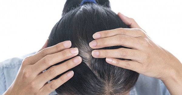 3 cách chữa tóc bạc sớm bạn phải biết