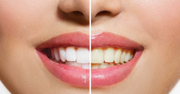 Răng trắng cực nhanh chỉ với 1 loại rau