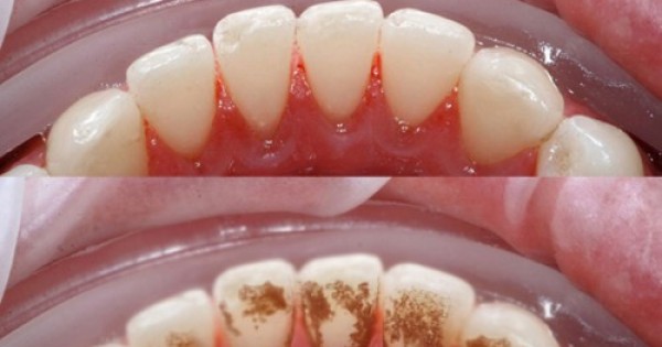 4 cách lấy cao răng từ thiên nhiên bạn nên biết