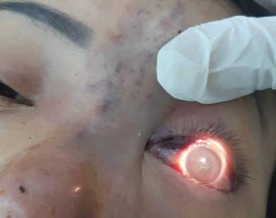 Cơ sở spa tiêm filler khiến bệnh nhân mù mắt bị phạt nặng