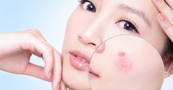 Trị mụn trứng cá hiệu quả cho những nàng lười