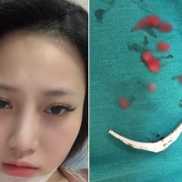 Lại thêm 1 cô gái tiêm filler kém chất lượng khiến cằm biến dạng