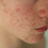 Thực phẩm bạn cần ăn để tránh mụn trứng cá