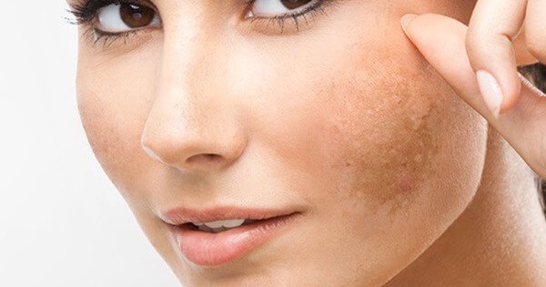 Lý do khiến làn da của bạn mãi xấu