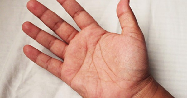 4 dấu hiệu ở lòng bàn tay cảnh báo bệnh nguy hiểm