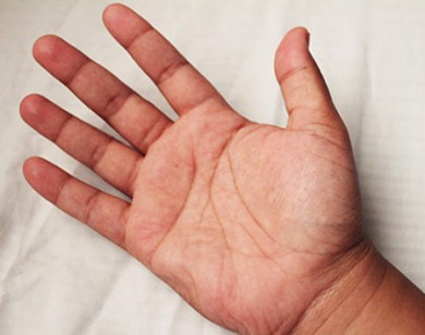 4 dấu hiệu ở lòng bàn tay cảnh báo bệnh nguy hiểm