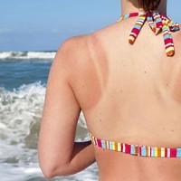 4 vấn đề về da thường gặp trong mùa hè
