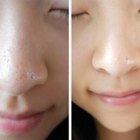 3 cách trị mụn đầu đen tại nhà cực nhanh
