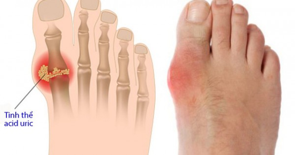 Không muốn bị bệnh gout thì hãy hạn chế thực phẩm này