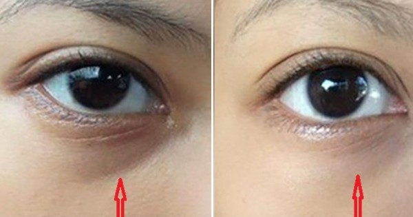 3 cách chữa thâm mắt vô cùng đơn giản