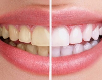 3 công thức tẩy trắng răng tại nhà đơn giản có thể bạn chưa biết