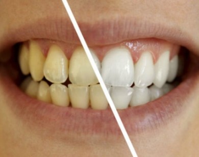 Cách đơn giản để giải quyết răng ố vàng bạn phải biết