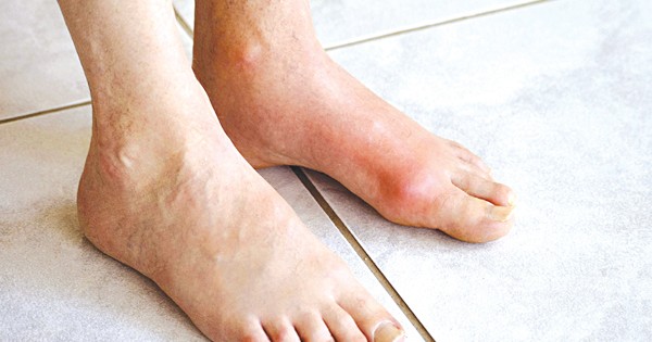 Người bị bệnh gout nên ăn thực phẩm nào?