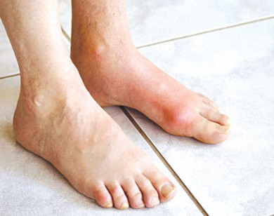 Người bị bệnh gout nên ăn thực phẩm nào?