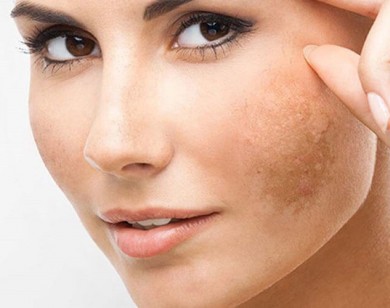 4 công thức đơn giản giúp bạn sạch nám da