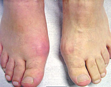 Thực phẩm người bị bệnh Gout không nên ăn