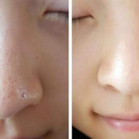 4 mẹo se lỗ chân lông tại nhà