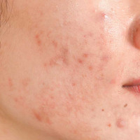 Giải quyết triệt để tình trạng thâm mụn tại nhà