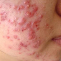 Thủ phạm gây mụn trứng cá không phải ai cũng biết